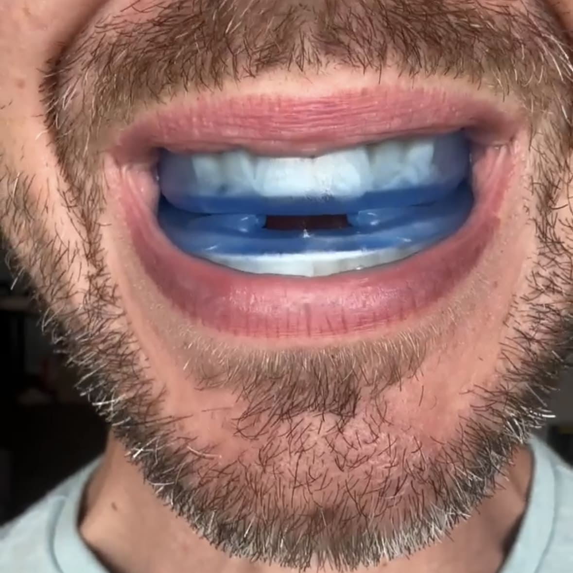 SleepShield™ - Anti-Snoring Mouthpiece