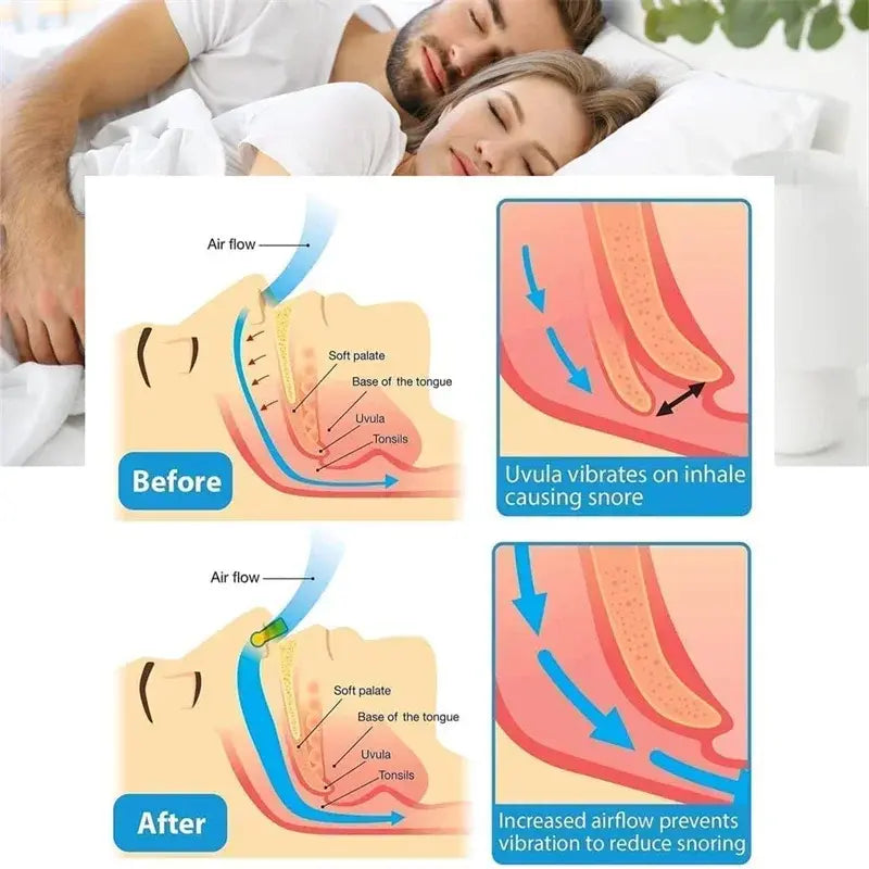 SleepShield- Anti-Snoring Nose Clip